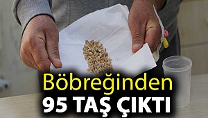 Böbreğinden 95 taş çıktı