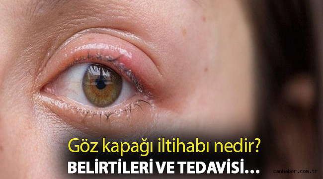 Goz Kapagi Iltihabi Nedir Belirtileri Ve Tedavisi Gundem Can Haber