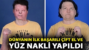 Dünyanın ilk başarılı çift el ve yüz nakli yapıldı: 'Bana verilen bu ikinci şans için minnettarız'