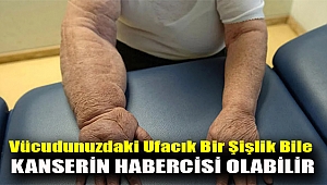 Vücudunuzdaki ufacık bir şişlik bile kanserin habercisi olabilir
